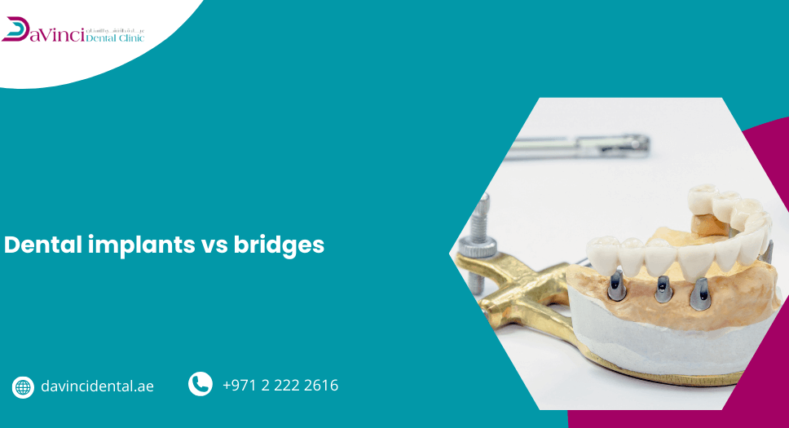 Dental Implants vs Bridges
