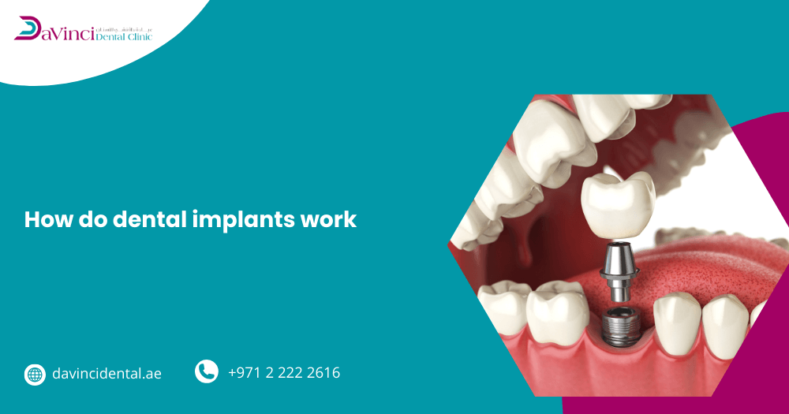 How Do Dental Implants Work