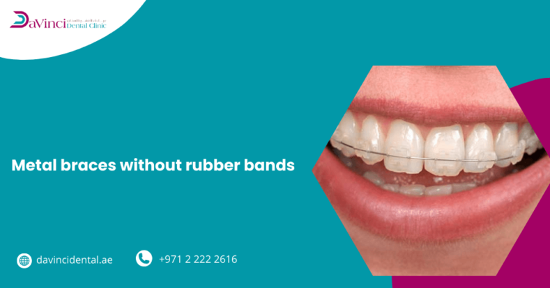 Metal Braces Without Rubber Bands