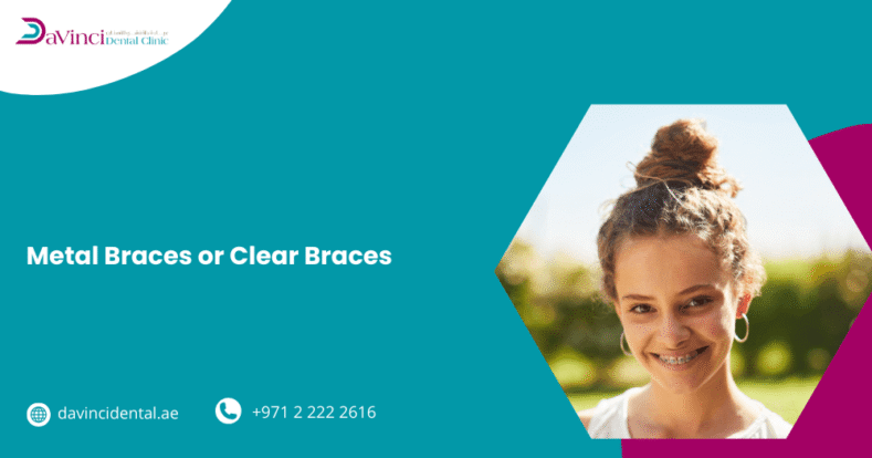 Metal Braces or Clear Braces