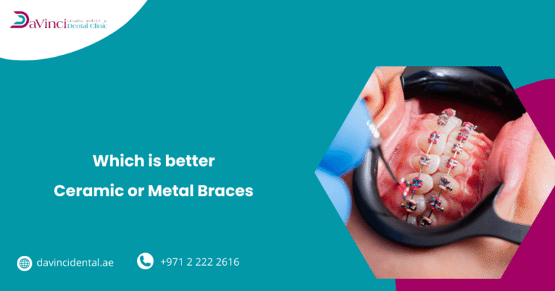 Which is Better, Ceramic or Metal Braces