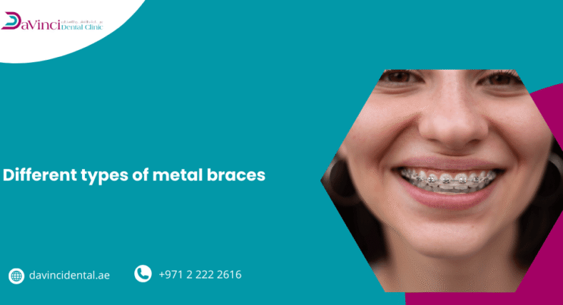 Different Types of Metal Braces