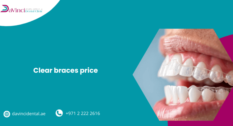 Clear Braces Price
