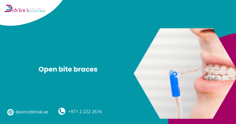 Open Bite Braces