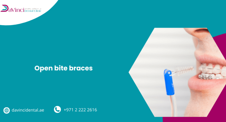 Open Bite Braces