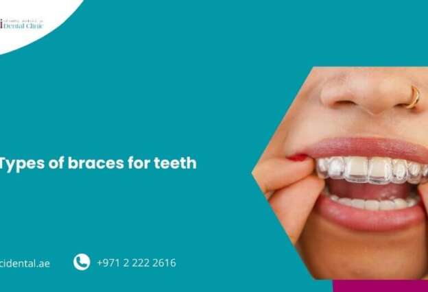 Types of Braces for Teeth