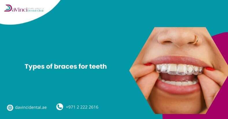 Types of Braces for Teeth
