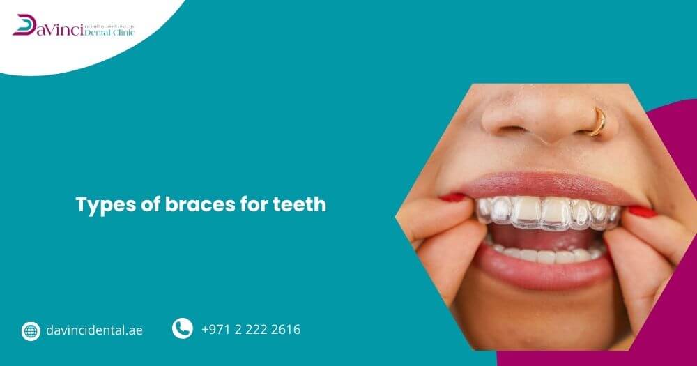 Types of Braces for Teeth