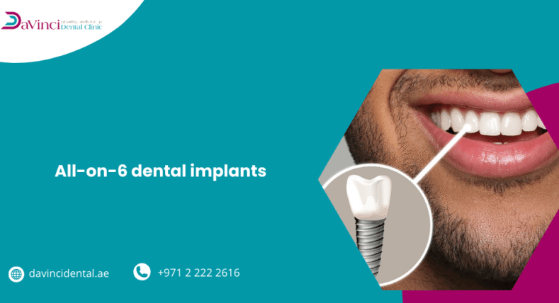All-on-6 Dental Implants