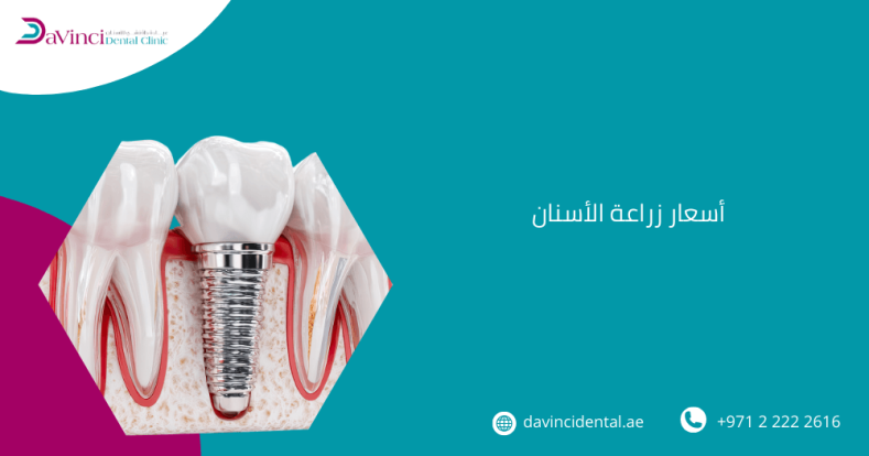 أسعار زراعة الأسنان