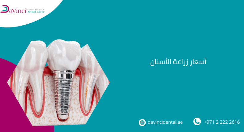 أسعار زراعة الأسنان