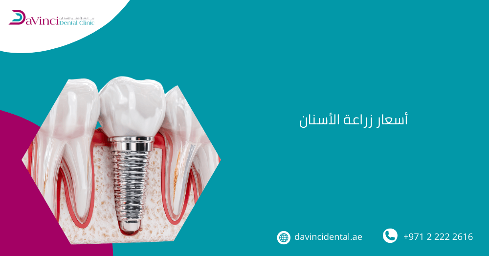 أسعار زراعة الأسنان