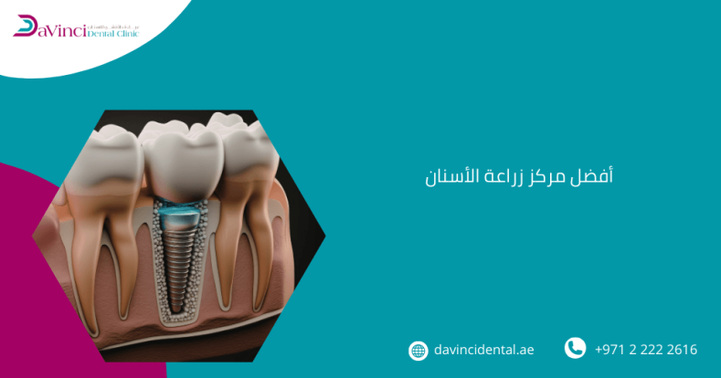 أفضل مركز زراعة الأسنان في أبو ظبي