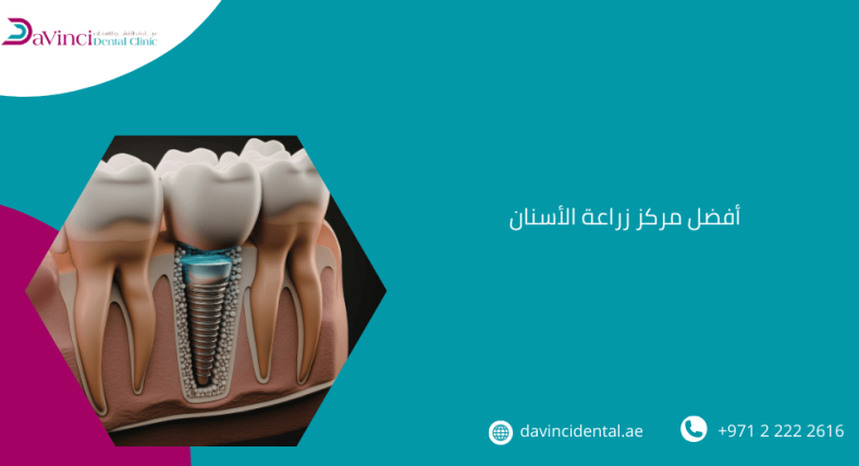 أفضل مركز زراعة الأسنان في أبو ظبي