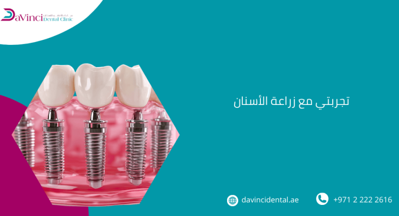 تجربتي مع زراعة الأسنان