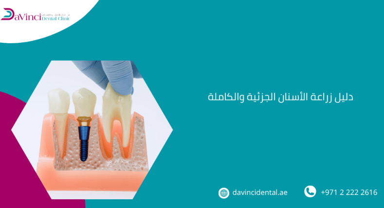دليل زراعة الأسنان الجزئية والكاملة