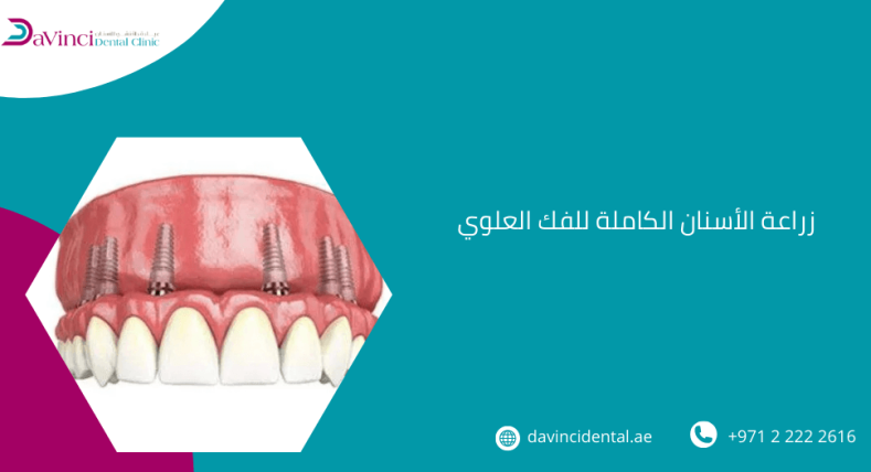 زراعة الأسنان الكاملة للفك العلوي
