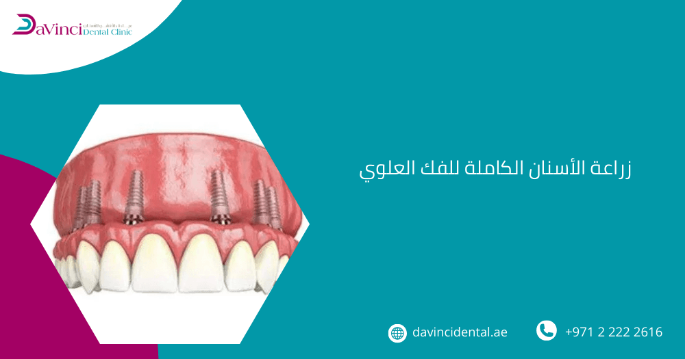 زراعة الأسنان الكاملة للفك العلوي