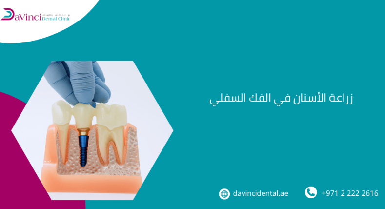 زراعة الأسنان في الفك السفلي