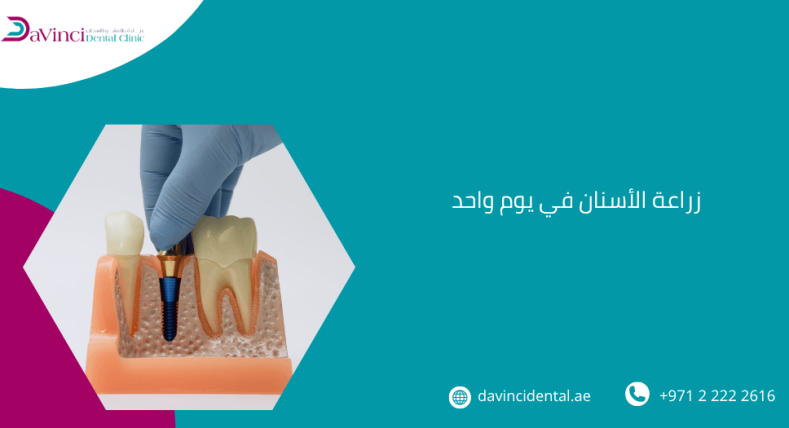 زراعة الأسنان في يوم واحد