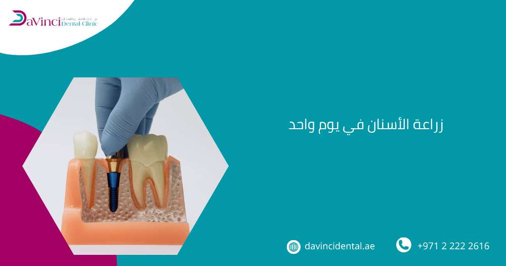 زراعة الأسنان في يوم واحد