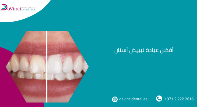 أفضل عيادة تبييض أسنان
