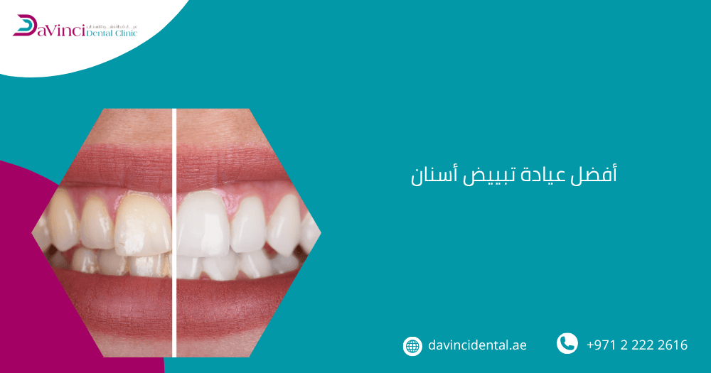 أفضل عيادة تبييض أسنان