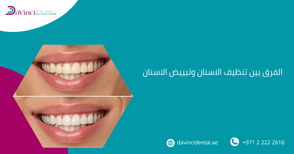 الفرق بين تنظيف الاسنان وتبييض الاسنان