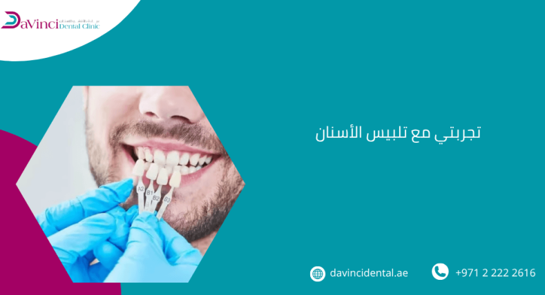 تجربتي مع تلبيس الأسنان