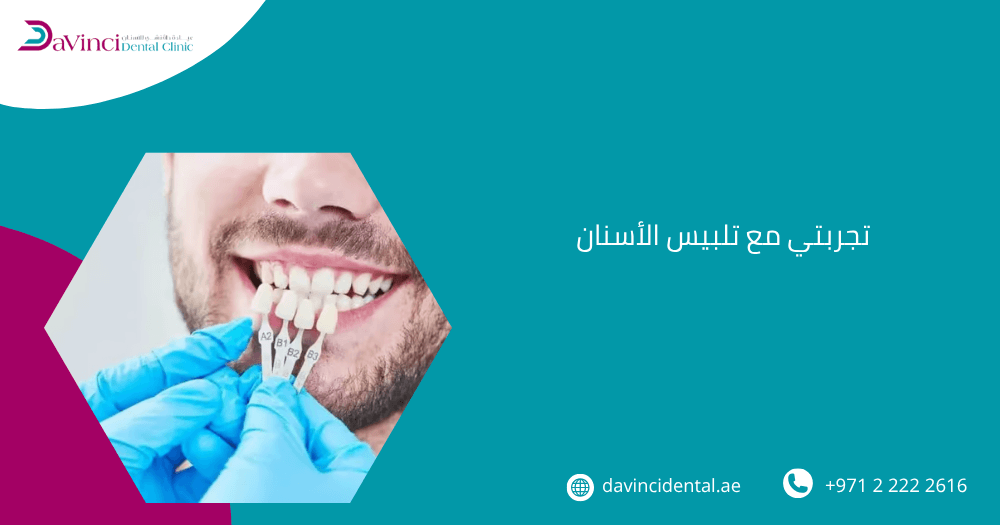 تجربتي مع تلبيس الأسنان