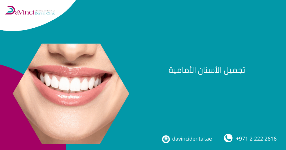 تجميل الأسنان الأمامية