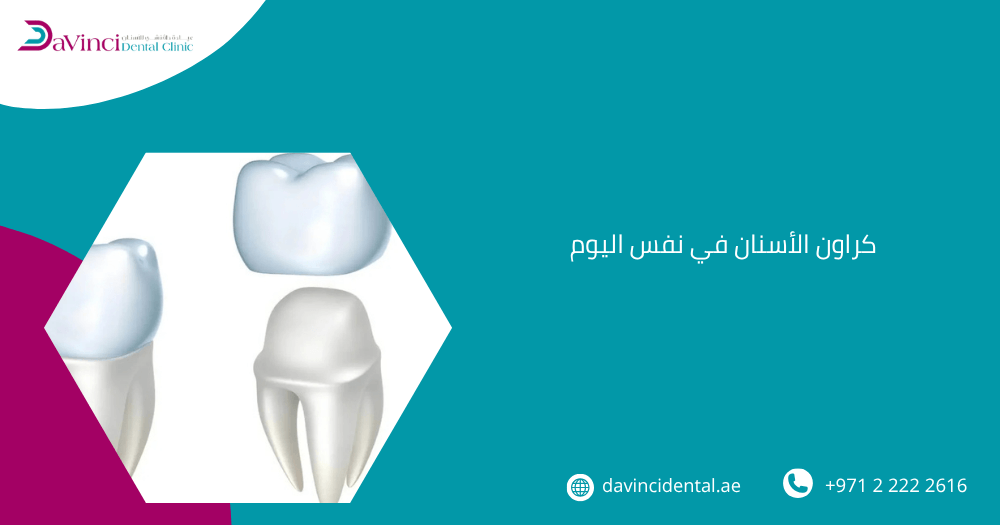 كراون الأسنان في نفس اليوم