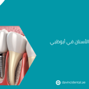 أفضل عروض زراعة الأسنان في أبوظبي | مركز دافنشي لطب الأسنان