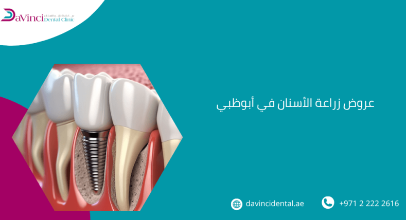 عروض زراعة الأسنان في أبوظبي