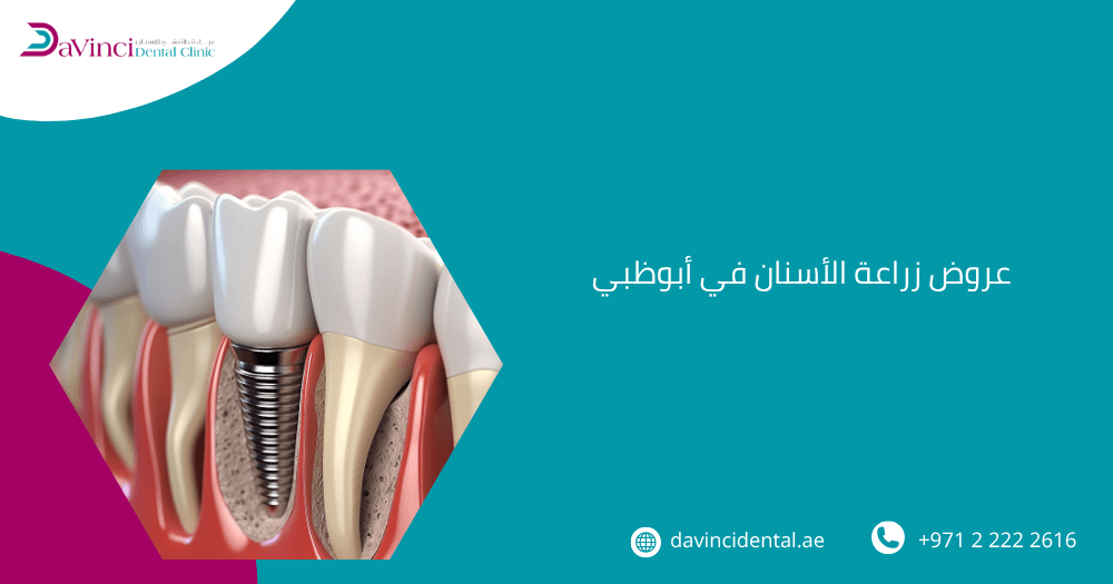 عروض زراعة الأسنان في أبوظبي
