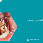 علاج قناة الجذر في أبو ظبي