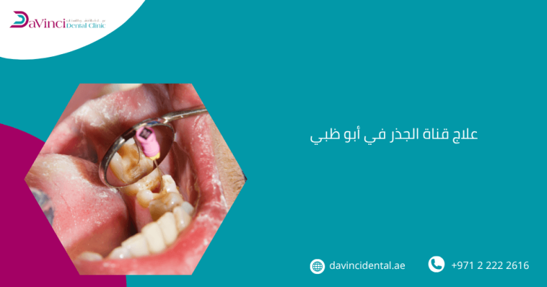 علاج قناة الجذر في أبو ظبي 