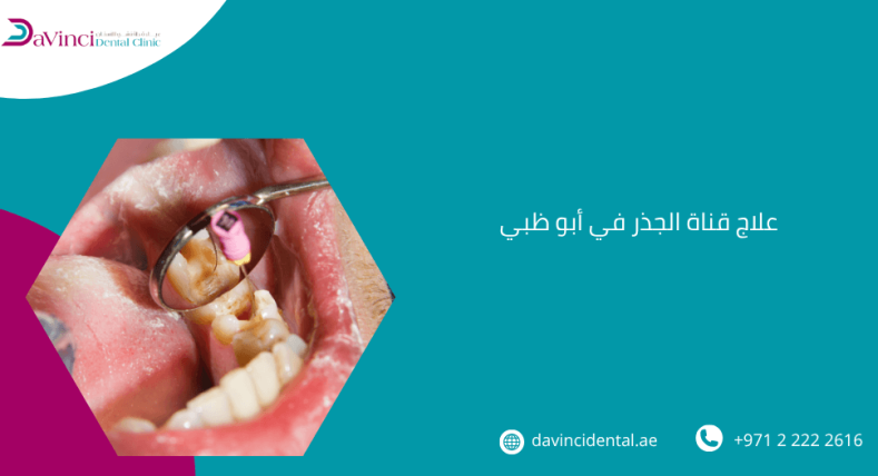 علاج قناة الجذر في أبو ظبي 