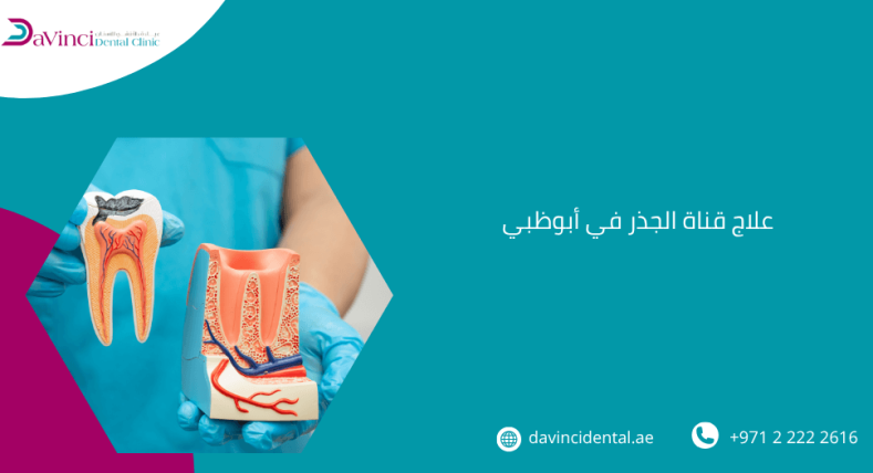 علاج قناة الجذر في أبوظبي