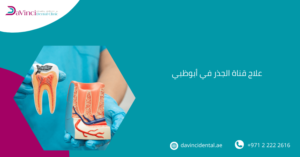 علاج قناة الجذر في أبوظبي